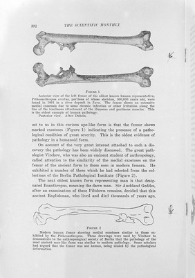 Interior view of the left femur of Pithecanthropus Erectus.