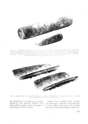 Splint found in ancient cliff dwellings, South-West Colorado and wooden cupping impliments used by cliff dwellers South-West Colorado