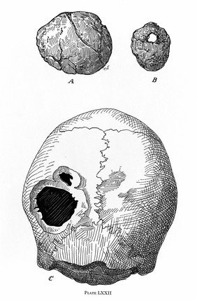Illustrations of trephanned skulls (A-C)
