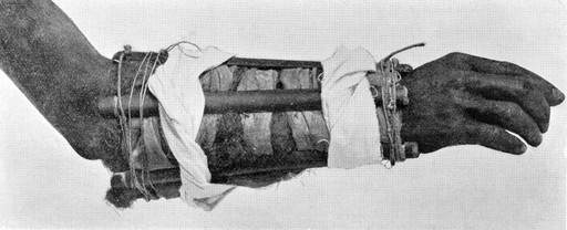 Native Sudanese splints applied to forearm from Medical Practices and Superstitions among the people
