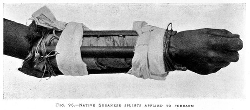 Native Sudanese splints applied to forearm from Medical Practices and Superstitions among the people