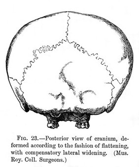 Posterior view of cranium deformed according to fashion