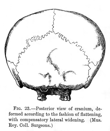 Posterior view of cranium deformed according to fashion