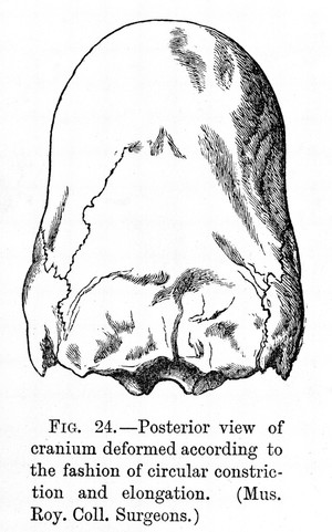 view Posterior view of cranium deformed according to fashion