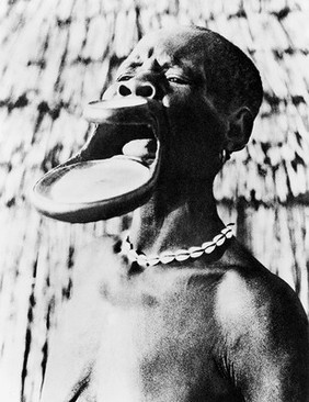 Sara woman with duck-bill modification of the lips.