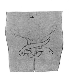 El-Lazien in situ: clamp used during Kordajan circumcision. Anglo Egyptian, Sudan. 