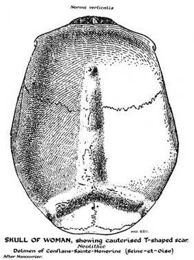 Skull of woman showing cauterised T-shaped scar, Neolithic. Dolmen of Conflans-Sainte-Honorine (seine-Et-Oise)