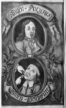 Treatment of nasal polypus, 17th Century