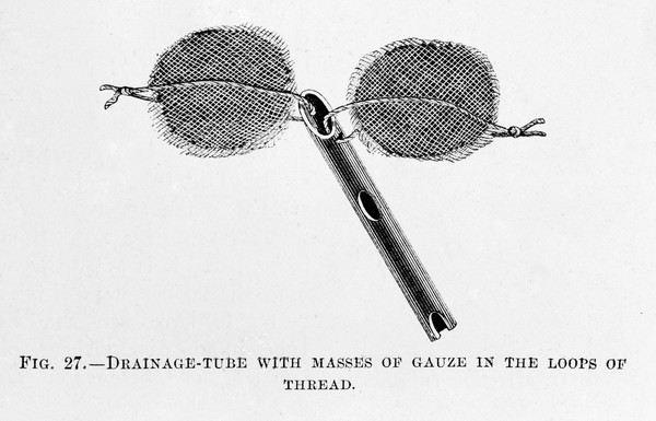 M0007799: Drainage tube with masses of gauze, from Cheyne: <i>Antiseptic Surgery</i> (1882)