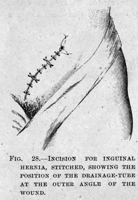 Lister, Inguinal hernia...Cheyne, Antiseptic Surgery