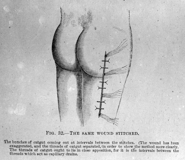 M0007802: Stitched wound, from Cheyne: <i>Antiseptic Surgery</i> (1882)