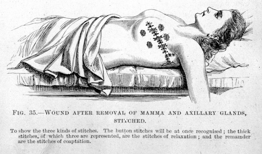 M0007803: Wound after removal of mamma and axillary glands, from Cheyne: <i>Antiseptic Surgery</i> (1882)