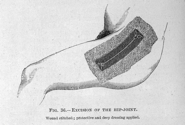 M0007804: Excision of the hip joint, from Cheyne: <i>Antiseptic Surgery</i> (1882)