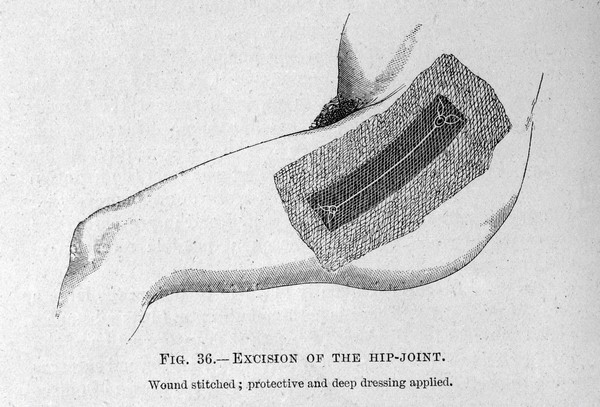 Lister, Excision wound stitched, dressed, Antiseptic Surgery