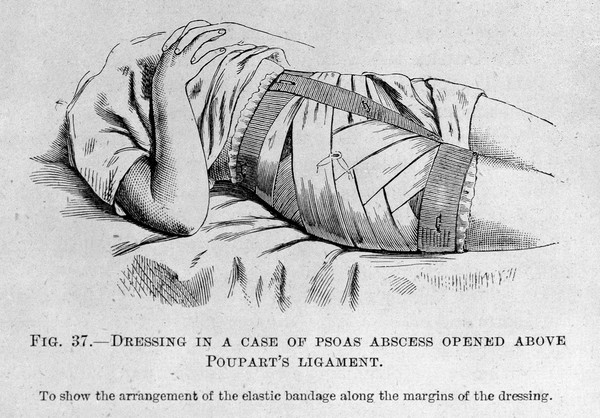 M0007805: Surgical dressing, from Cheyne: <i>Antiseptic Surgery</i> (1882)
