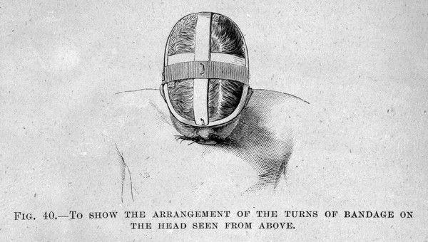 M0007808: Bandage on the head, from Cheyne: <i>Antiseptic Surgery</i> (1882), from Cheyne: <i>Antiseptic Surgery</i> (1882) / M0007809: Breast dressings, from Cheyne: <i>Antiseptic Surgery</i> (1882)