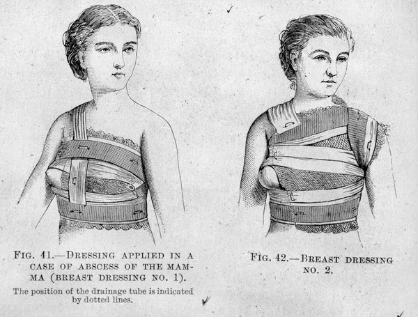 M0007808: Bandage on the head, from Cheyne: <i>Antiseptic Surgery</i> (1882), from Cheyne: <i>Antiseptic Surgery</i> (1882) / M0007809: Breast dressings, from Cheyne: <i>Antiseptic Surgery</i> (1882)