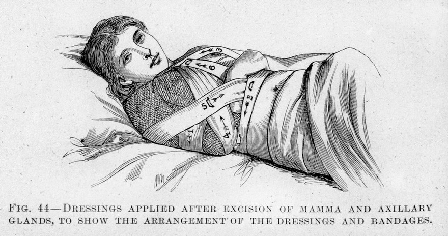 M0007810: Breast dressings and bandages, from Cheyne: <i>Antiseptic Surgery</i> (1882)
