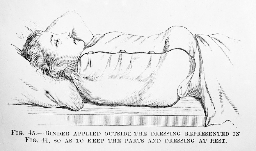 M0007811: Binder outside breast dressing, from Cheyne: <i>Antiseptic Surgery</i> (1882)