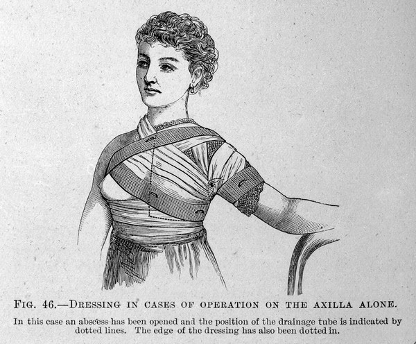 M0007812: Axilla operation dressing, from Cheyne: <i>Antiseptic Surgery</i> (1882)