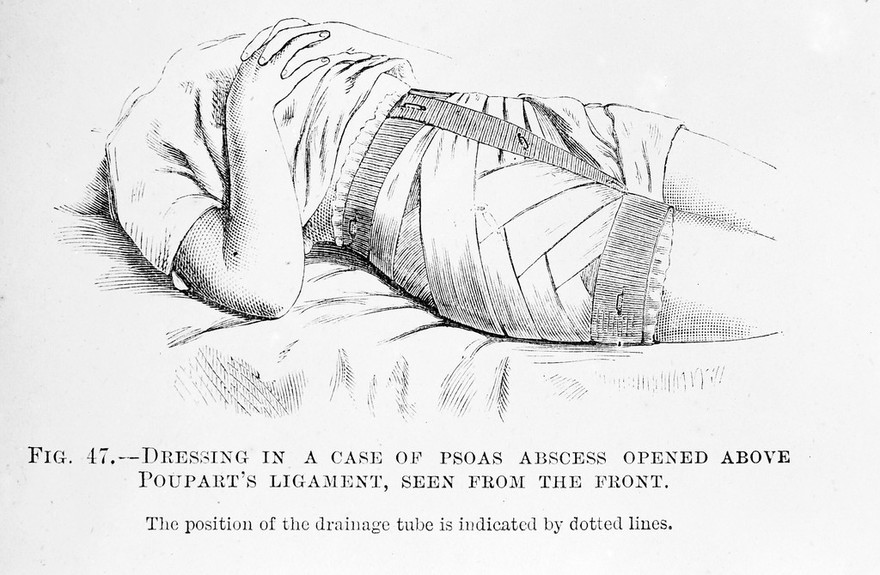 M0007813: Dressing for abscess with drainage tube, from Cheyne: <i>Antiseptic Surgery</i> (1882)