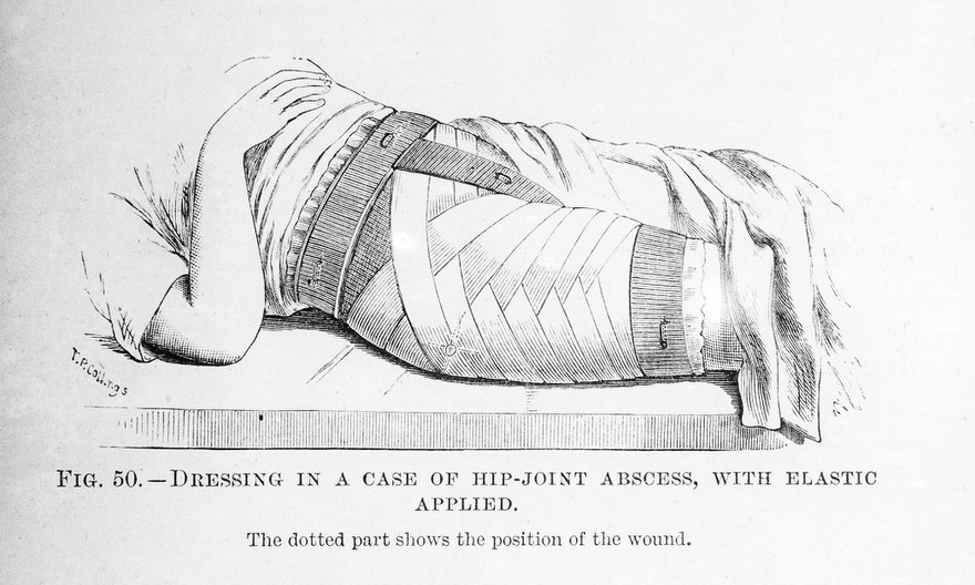 M0007816: Hip joint abscess dressing, from Cheyne: <i>Antiseptic Surgery</i> (1882)