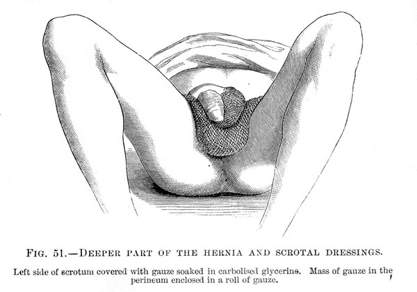 M0007817: Hernia and scrotal dressings, from Cheyne: <i>Antiseptic Surgery</i> (1882) / M0007819: Hernia and scrotal dressings from the left side, from Cheyne: <i>Antiseptic Surgery</i> (1882)