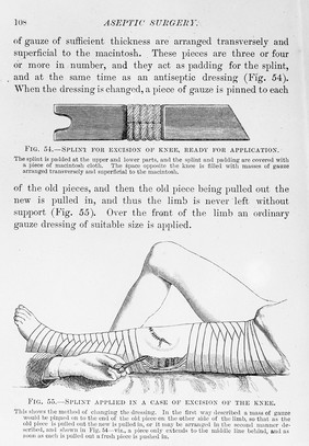 Lister, Splint for knee excision, Antiseptic Surgery.