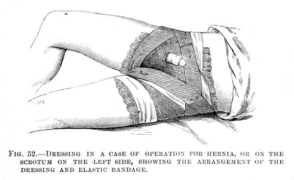 M0007817: Hernia and scrotal dressings, from Cheyne: <i>Antiseptic Surgery</i> (1882) / M0007819: Hernia and scrotal dressings from the left side, from Cheyne: <i>Antiseptic Surgery</i> (1882)