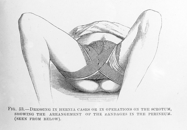 Lister, Hernia dressing..., Cheyne, Antiseptic Surgery.