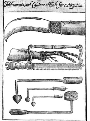 view Figure of 18th century amputation from Lowe's chyrurgerie.