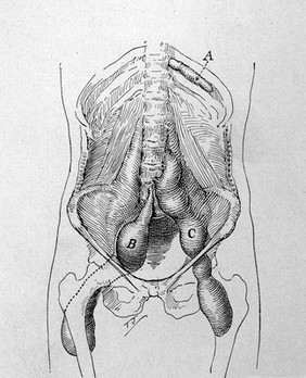 Diagramo types of abcesses due to vertibral tuberculosis