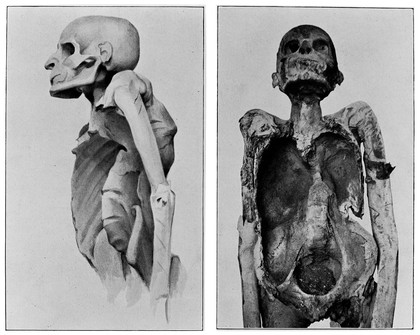 Pott'sche Krankheit an einer ägyptischen Mumie aus der Zeit der 21 Dynastie (um 1000 v. chr.) / Grafton Elliot Smith und Marc Armand Ruffer.