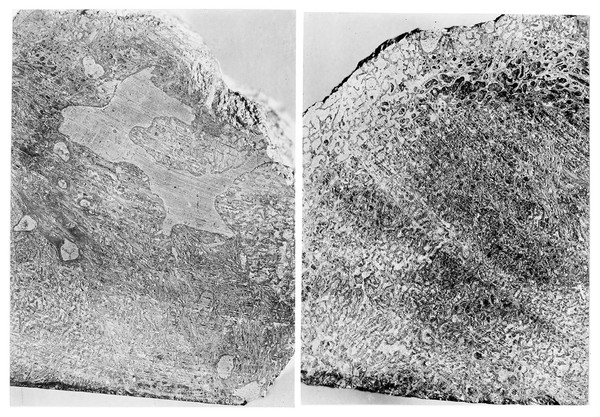 Fossil Haemangioma, sections through Dinosaur tumour