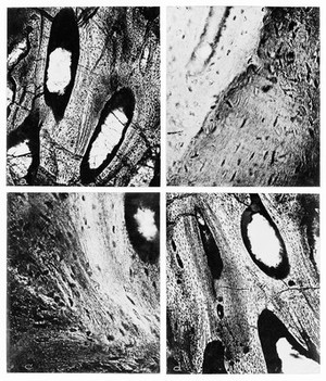 view Photomicrographs, histology of dinosaur tumour