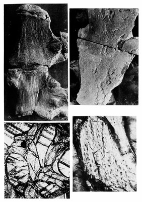 A cretaceous osteoma (a-d), neoplasm of bone