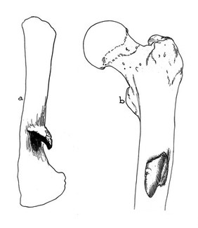 Ancient chronic infections (a-b) 