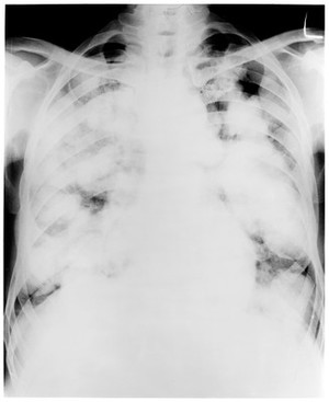 view X-ray of chest showing tuberculosis