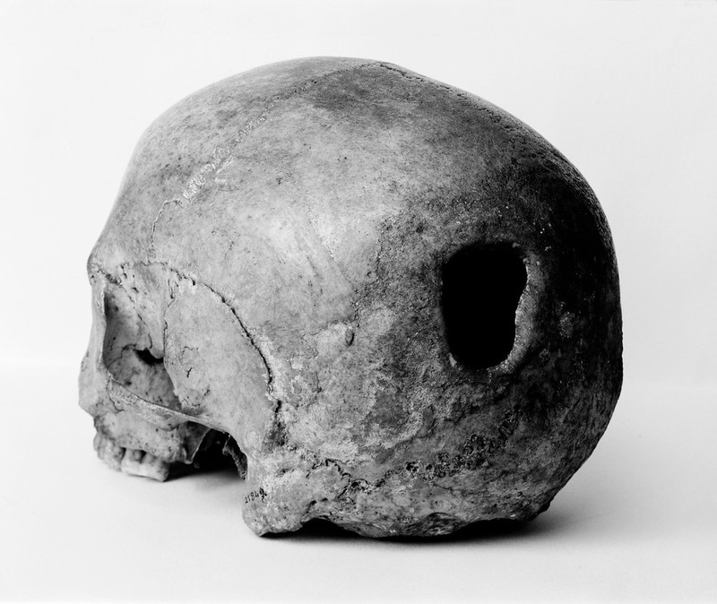 M0009393: Edinburgh Skull with trepanned hole in back of skull
