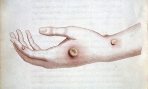 view The hand of Sarah Nelmes infected with the cowpox.