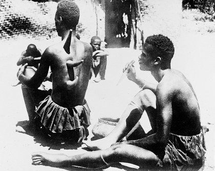 African witch doctor cupping a patient, Wide World photograph