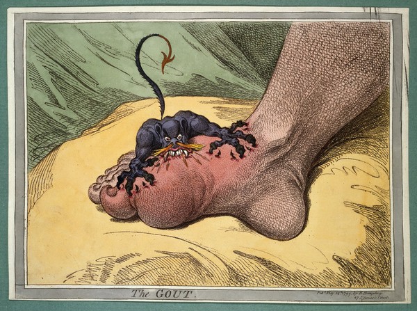 A swollen and inflamed foot: gout is represented by an attacking demon. Coloured soft-ground etching by J. Gillray, 1799.