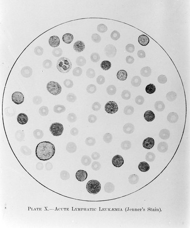 Blood smear showing acute lymphatic leukaemia.