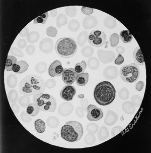 view Blood smear showing erythroblastosis fetalis; giemsa stain.