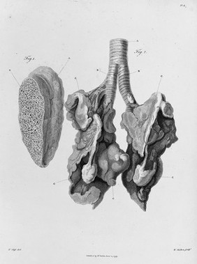 Section of lung of Samuel Johnson. Postmortem examination showed that Johnson had suffered from emphysema of the lungs.