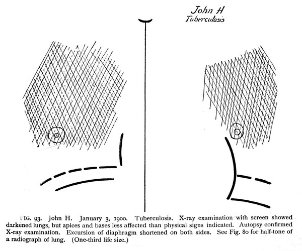M0013466: Diagram made from x-ray of a patient diagnosed with tuberculosis.