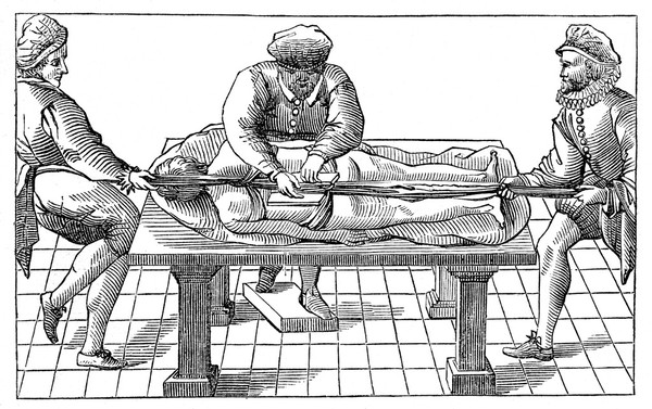 Correction of dislocation of the spine. Drawing related to Pare. Les oeuvres d'Ambroise Pare 1585 in the Lancet.