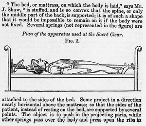 view Apparatus for correction of dislocation of the spine.