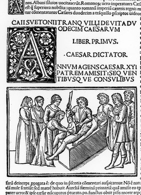 The birth of the Julius Caesar by Caesarian section.