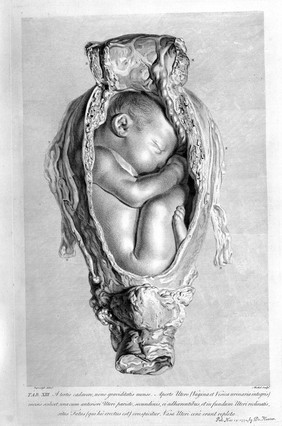 Anatomia uteri humani gravidi tabulis illustrata ... The anatomy of the human gravid uteris exhibited in figures / [William Hunter].